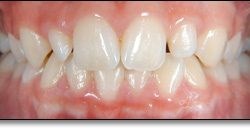 Eastbridge Dental Care: To Take Effective Care Of Your Dental Implants